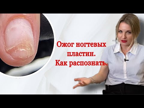 Видео: СЛУЧАЙ ИЗ ПРАКТИКИ/ ОЖОГ/ ОНИХОЛИЗИС/ КАК НЕ ДОЛЖЕН РАБОТАТЬ МАСТЕР