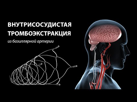 Видео: Тромбоэкстракция в лечении инсульта.