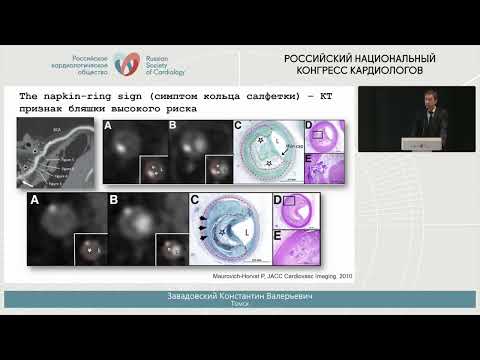 Видео: КТ-КОРОНАРОГРАФИЯ ИЛИ ИНВАЗИВНАЯ КОРОНАРОГРАФИЯ: НЕ ВСЕГДА ОЧЕВИДНЫЙ ВЫБОР