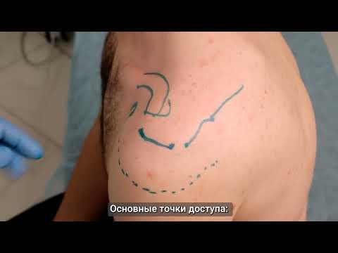 Видео: Хронотрон. Техника внутрисуставной инъекции в плечевой сустав. Задний доступ.