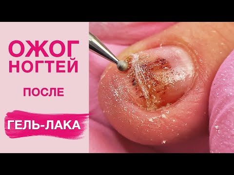 Видео: Ожог ногтевой пластины | Зачистка онихолизиса
