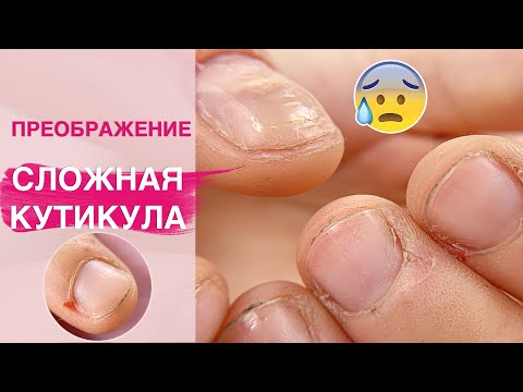 Видео: СЛОЖНАЯ налипшая кутикула вся в РАНАХ и трещинах 😰 | Наращивание ногтей полигелем