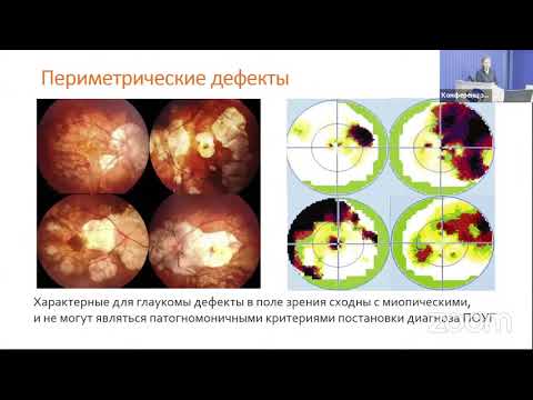 Видео: Снижение зрения. Всегда ли виновата глаукома?