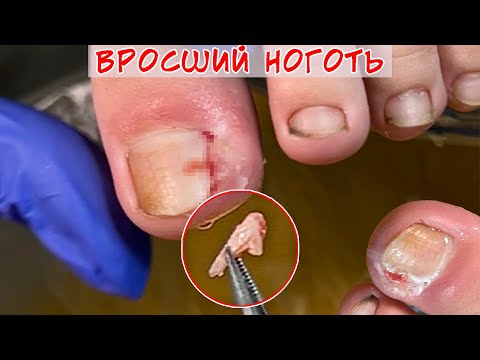 Видео: Вросший ноготь после травмы / Вросший ноготь у ребенка