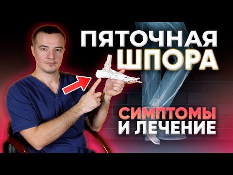 Видео: Как избавиться от пяточной шпоры: советы травматолога-ортопеда по терапии Плантарного фасциита