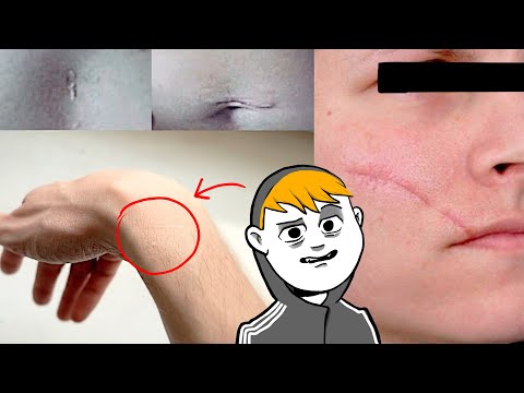 Видео: ИСТОРИЯ МОИХ ШРАМОВ