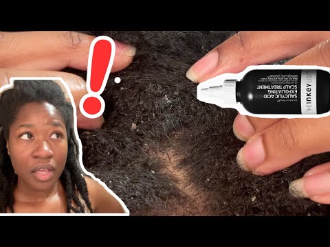 Видео: Можно ли вылечить перхоть? День 1.