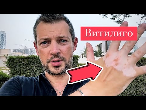 Видео: У меня ВИТИЛИГО! Что ЭТО и как с этим жить?! /// Как лечить витилиго?!