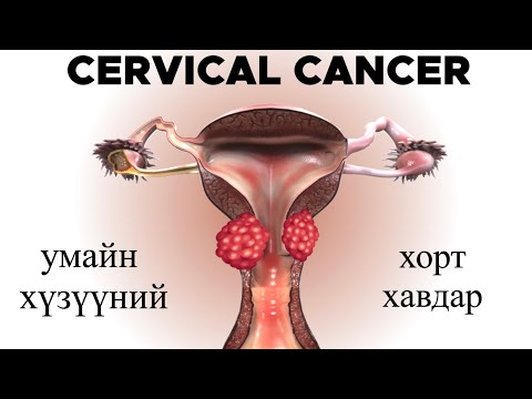 Видео: умайн хүзүүний хорт хавдраас хэрхэн сэргийлэх вэ ?