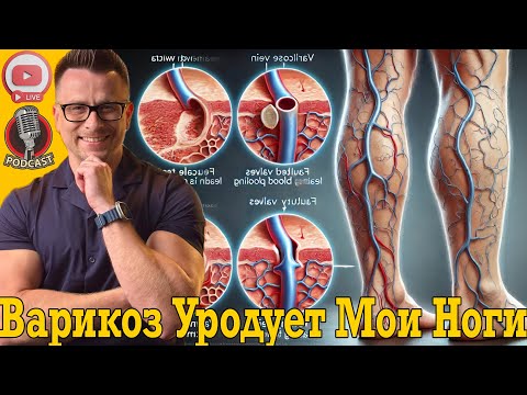 Видео: Варикоз уродует мои ноги!