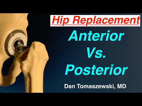 Видео: Передняя и задняя замена тазобедренного сустава