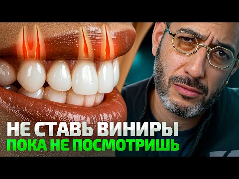 Видео: Все виды виниров в 1 видео. Что выбрать в 2026?