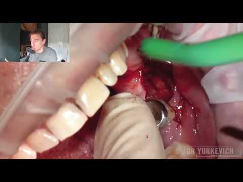 Видео: Как удалить непрорезавшийся нижний зуб мудрости? Подробный видео разбор по кейсу с полной ретенцией