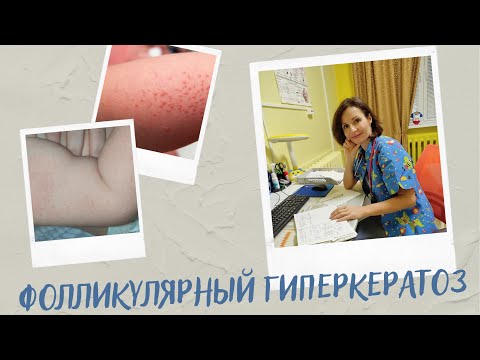 Видео: Фолликулярный гиперкератоз - что это? Его часто путают с атопическим дерматитом. Как отличить?