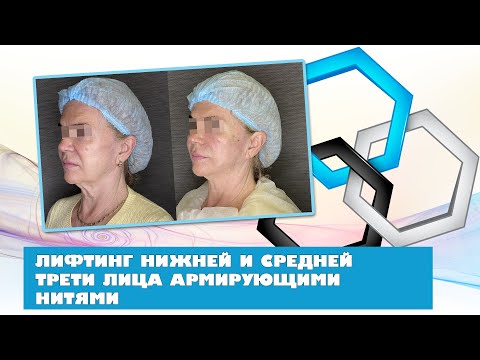 Видео: Имплантация армирующих нитей с целью лифтинга средней и нижней трети лица