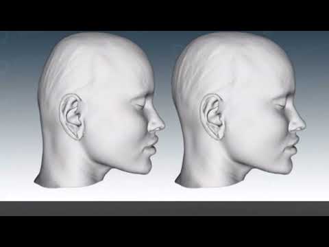 Видео: Эстетическая краниопластика с индивидуальным имплантом | Occipital Augmentation with Custom Implant