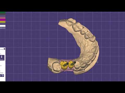 Видео: EXOCAD моделировка коронок на винтовой фиксации
