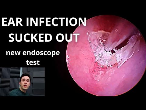 Видео: Инфекция уха удалена (новый эндоскопический тест)