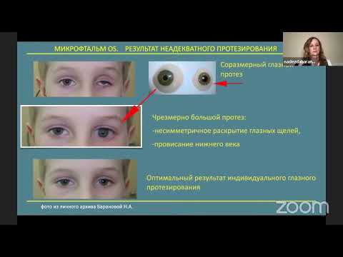 Видео: 4. Глазное протезирование в реабилитации детей с врожденным анофтальмом и микрофтальмом. ГП 2023