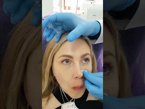 Видео: Коррекция обьема средней трети щеки филлерами Stylage.
