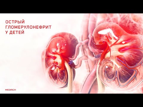 Видео: Острый постстрептококковый гломерулонефритю Часть1