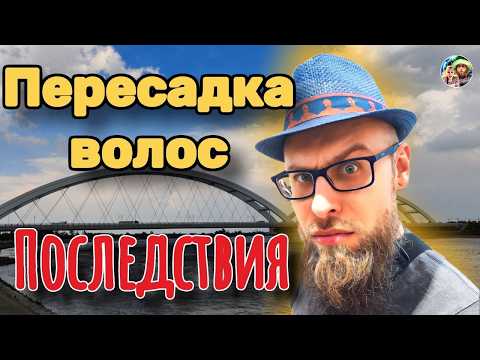 Видео: Пересадка волос: что случилось через год?