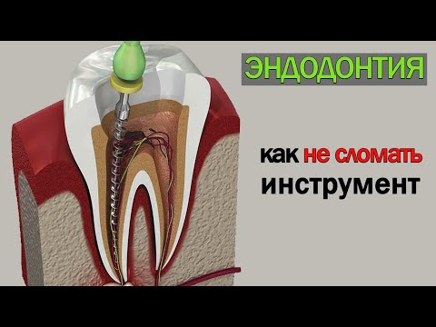 Видео: Как не сломать инструмент в корневых каналах зуба - эндодонтия причины поломок