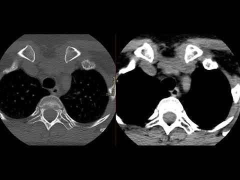 Видео: Укладка КТ шейного отдела позвоночника