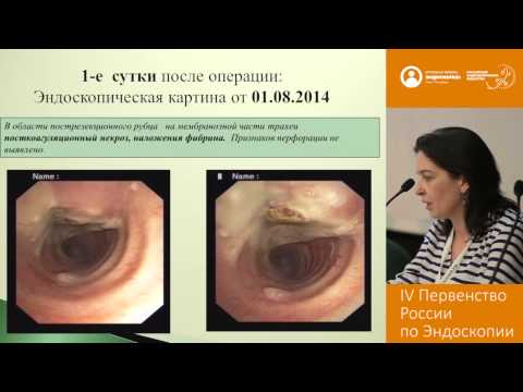 Видео: Органосохраняющее удаление неэпителиальной опухоли трахеи