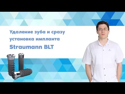 Видео: Удаление зуба и сразу имплант