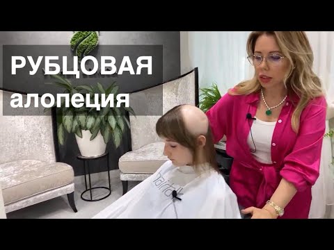 Видео: Рубцовая алопеция...Спасаем прическу.