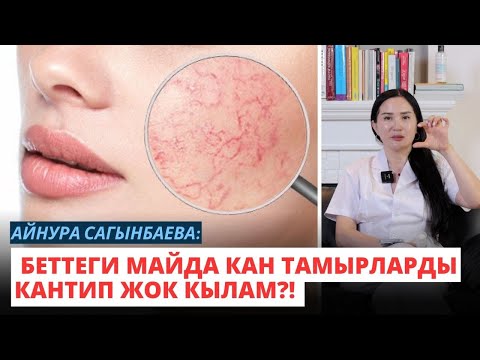 Видео: Айнура Сагынбаева: Беттеги майда кан тамырларды кантип жок кылам?! (купероз)