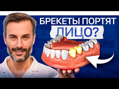 Видео: Большая скученность ЗУБОВ: когда НЕ нужно удалять премоляры? Кривые зубы ДО и ПОСЛЕ