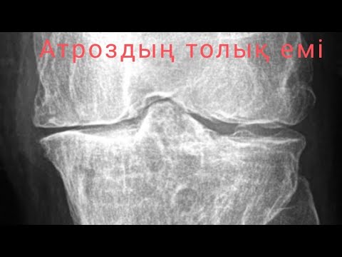 Видео: Тізе ауыруының толық емі. #артрозсуставов #артроз #гонартроз #артрит