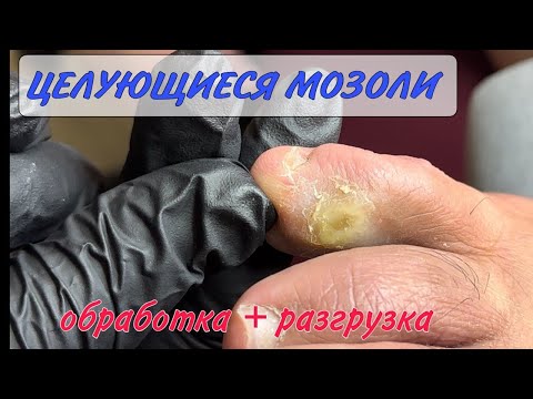 Видео: Целующиеся мозоли/ мозоли между пальцев/ разгрузка для мозоли