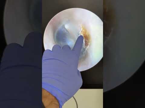 Видео: Лор болезни