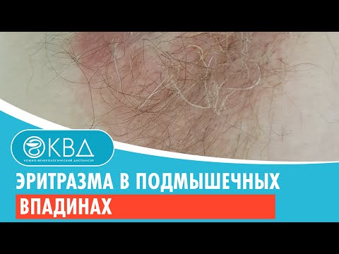 Видео: Эритразма в подмышечных впадинах. Клинический случай №137