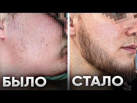Видео: от ПАЦАНА до БРУТАЛА за 5 месяцев! Результаты средства для роста бороды