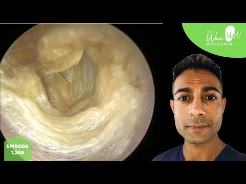 Видео: 1288 - Хирургическая тимпанопластика барабанной перепонки с отслоением омертвевшей кожи