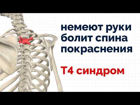 Видео: Немеют руки или голова, боль в пояснице? Лечим Т4 синдром так!