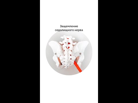 Видео: Защемление седалищного нерва во время беременности