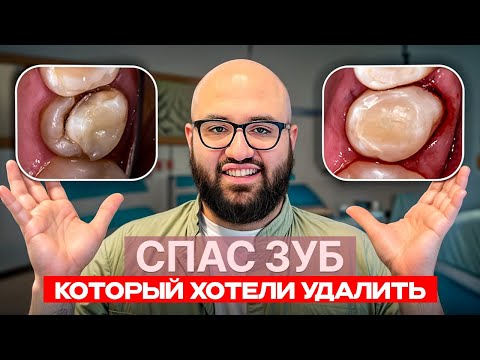 Видео: Спасение зуба за 6 минут! Шаг за шагом + результат.
