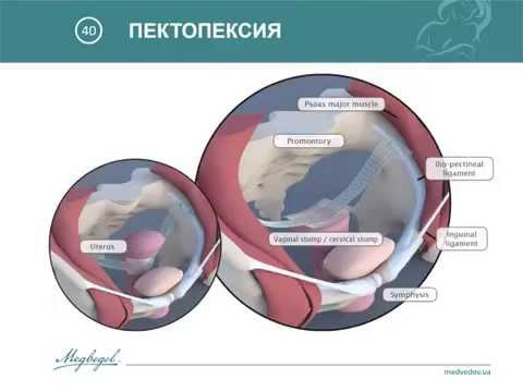 Видео: Генитальный пролапс взгляд с позиций пациент ориентированной медицины
