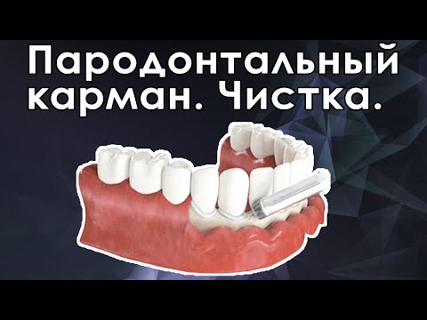 Видео: Открытый кюретаж