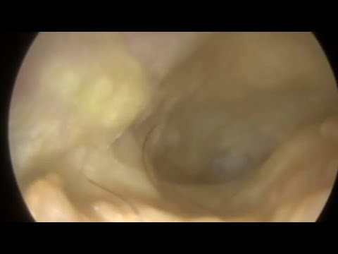 Видео: 853 - Микроаспирация при мокнущей ушной инфекции