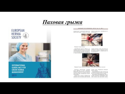 Видео: Паховая грыжа / Прямая, косая паховая грыжа / Inguinal hernia
