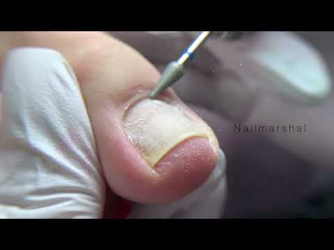 Видео: Педикюр/ эстетика в педикюре/ арочные ногти /высокие валики #педикюр #аппаратныйпедикюр #pinkroyss #