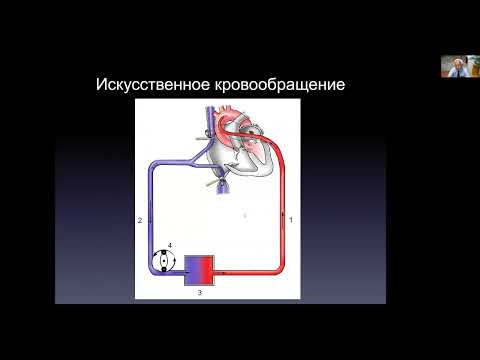 Видео: Искусственное кровообращение. Кардиохирургия для кардиологов. БМ-2. Профессор Шихвердиев Н.Н.
