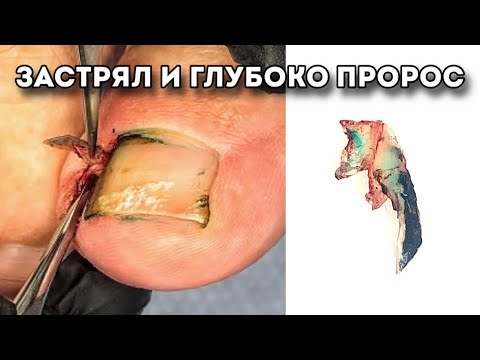 Видео: Не пытайтесь повторить! Удаление глубоко въевшейся части ногтя.