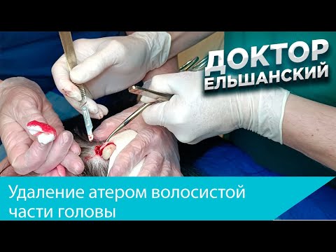 Видео: Удаление атером волосистой части головы
